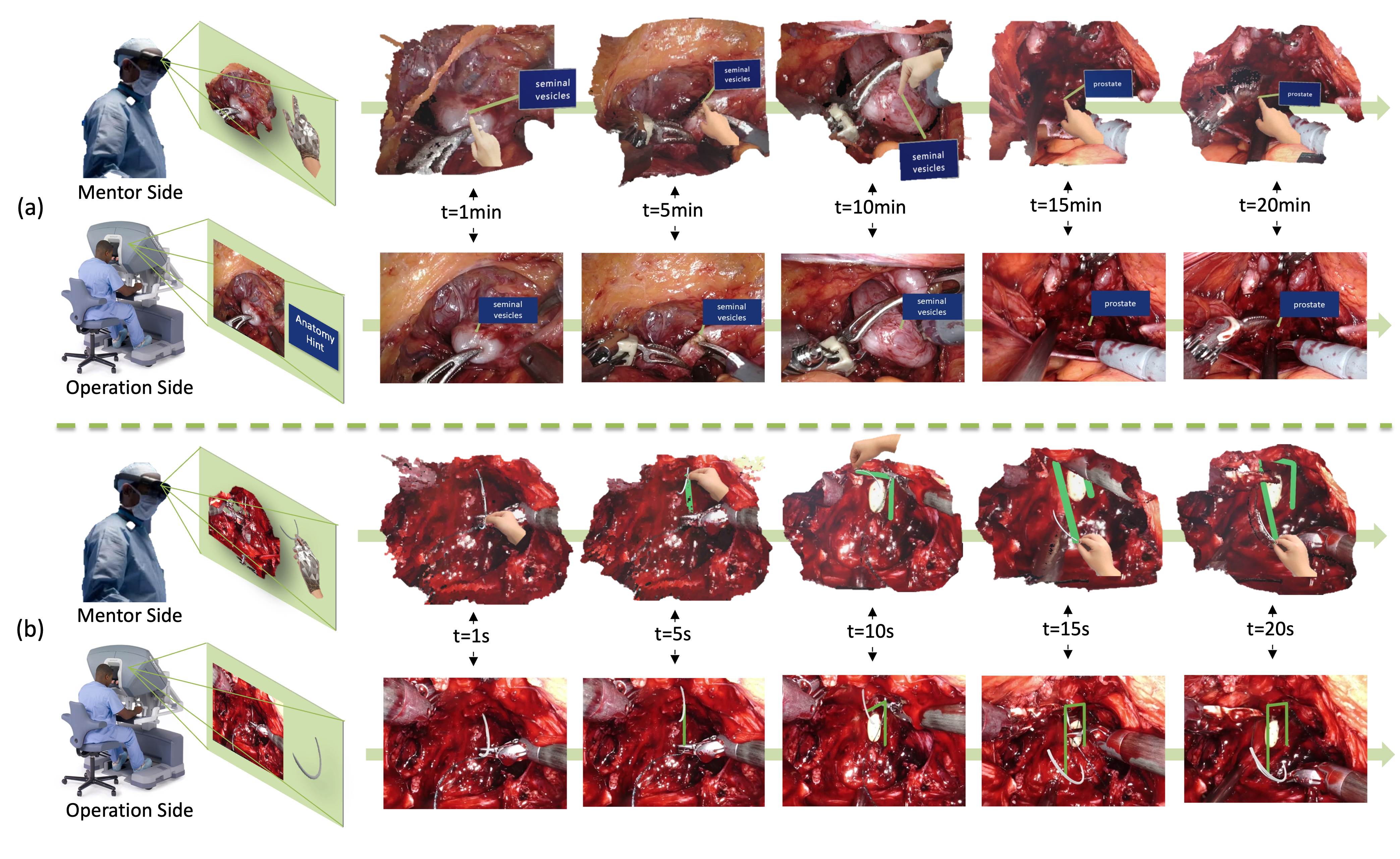 Robotic surgery remote mentoring via AR with 3D scene streaming and hand interaction